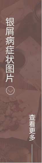 银屑病症状图片