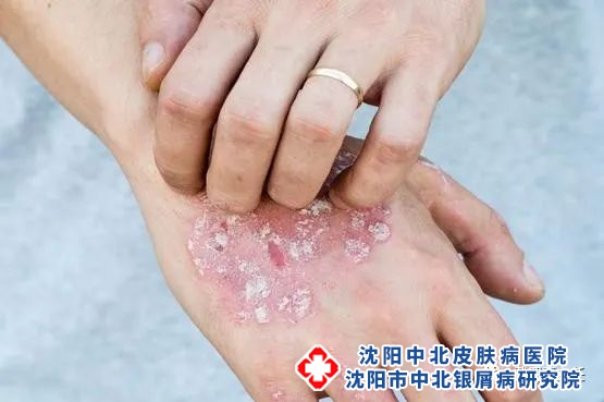 中医如何治疗银屑病?有没有治疗偏方?