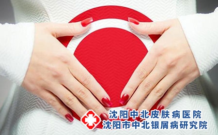 沈阳治疗牛皮癣的医院?【沈阳中北牛皮癣医院信誉好】