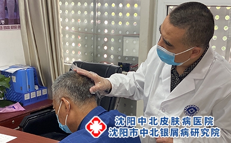 沈阳银屑病需要更换医院吗?【沈阳中北皮肤病医院冶疗皮肤病】