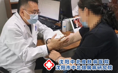 沈阳银屑病中医孙金奎：头部银屑病护理常识有哪些?