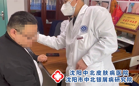 牛皮癣对肝脏的损害-沈阳医院治疗银屑病哪个效果好