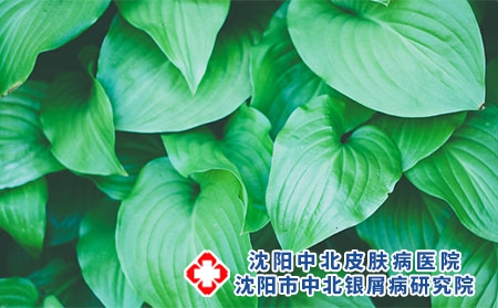 沈阳有哪些针剂可以治疗银屑病-沈阳银屑病中医治疗方法有哪些-生活中哪些人容易患牛皮癣呢?