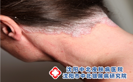 脸上银屑病怎么治疗