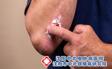 银屑病引起的肿胀怎么消退