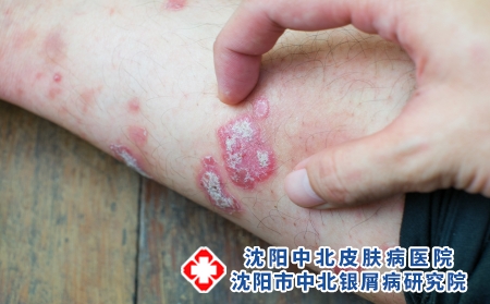 牛皮癣会隔代遗传吗