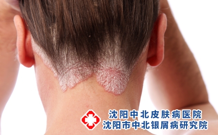 治疗头部长银屑病，为您解决根本问题的方法揭秘