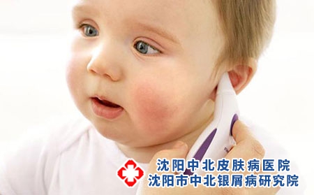 沈阳牛皮癣医院：如何防止小孩得牛皮癣