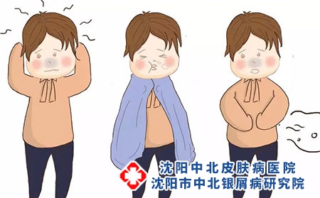被银屑病缠上，是不是一辈子都去不掉了?沈阳银屑病医院，沈阳牛皮癣医院，沈阳皮肤病医院