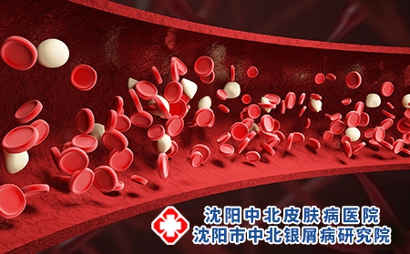 揭秘 | 银屑病是血液病吗?