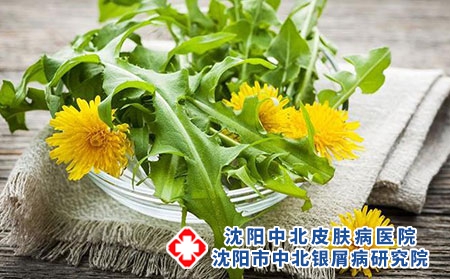 头皮型银屑病患者吃蒲公英管用吗?