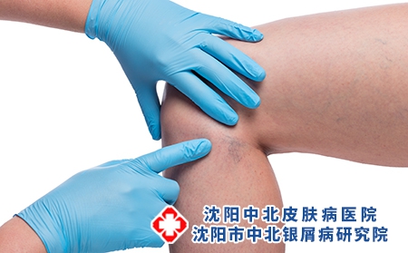 摄图网_303522806_医生亲手检查女腿和紧闭的容器上变血管（企业商用）
