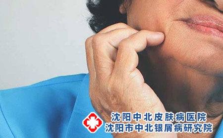 老年脓包型牛皮癣的治疗注意事项