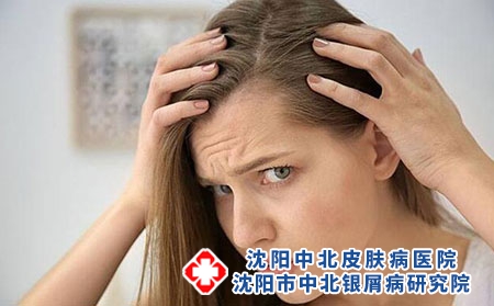 专家讲述脑袋上有牛皮癣怎么办