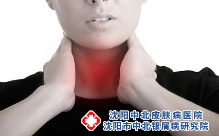 扁桃体炎可诱发牛皮癣 做好护理可以减少复发