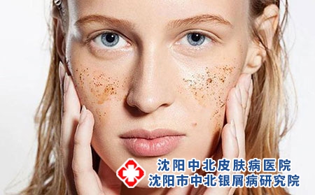 如何正确对待牛皮癣的鳞屑?