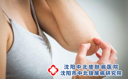 寻常型牛皮癣的症状?