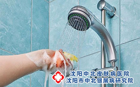 沈阳治疗银屑病医院：牛皮癣患者如何洗澡洗头?