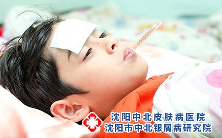 寻常性银屑病的传播途径?