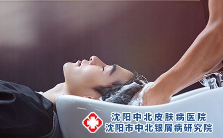 头部银屑病用什么洗头?