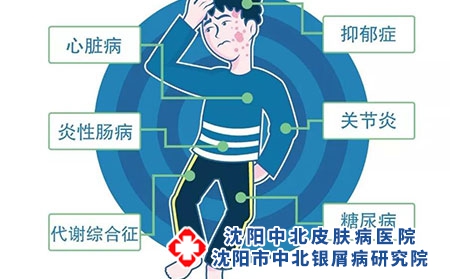 银屑病：全身侵袭的不止是皮肤
