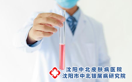 脓疱型牛皮癣诊断方法