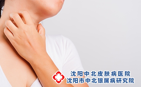银屑病分4种类型，不同的类型表现也不一样
