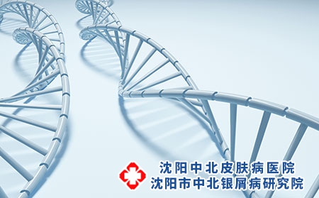 牛皮癣遗传规律是什么？