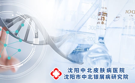 沈阳治疗银屑病的方法有哪些？