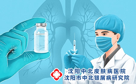 银屑病的治疗方法是什么?