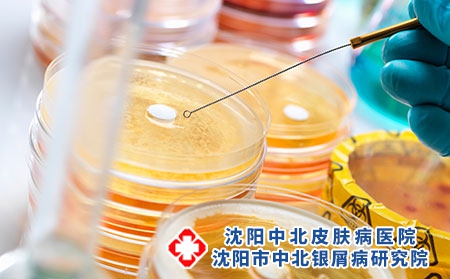 牛皮癣好了又发还能治得好吗？