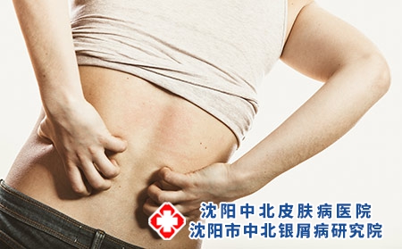 引起背部牛皮癣的原因有哪些