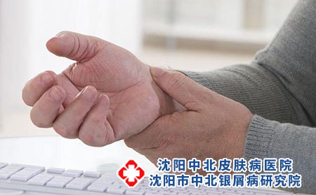 如果得了副牛皮癣可以治愈吗