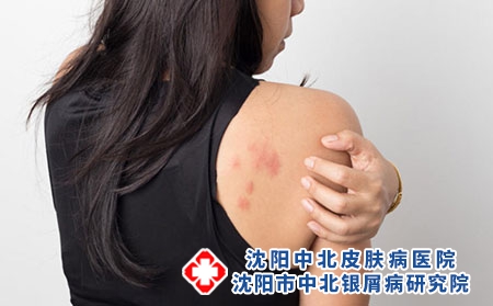 牛皮癣的5种临床类型分别是什么