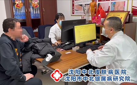 沈阳有没有专业治疗银屑病的医院牛皮癣严重不严重