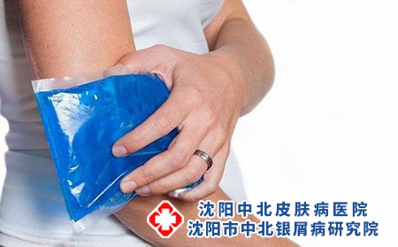 沈阳医生讲解银屑病性关节炎