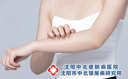 摄图网_501700721_皮肤过敏抓挠手臂的女性（企业商用）