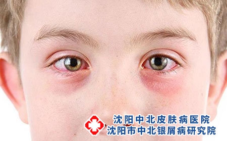 少年寻常型银屑病表现