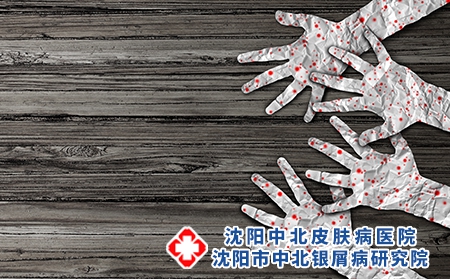 银屑病患者如何清除心理障碍？