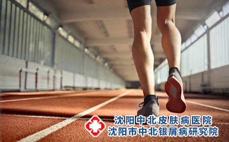 坚持锻炼可以改善银屑病吗
