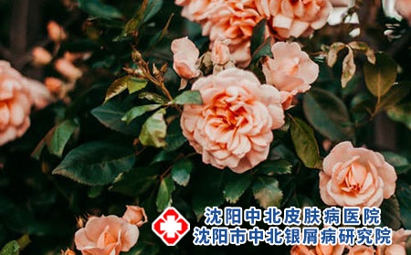 银屑病掉屑对身体会造成什么伤害？