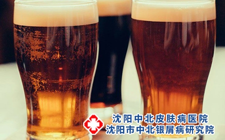 得了牛皮癣能喝啤酒吗 牛皮癣日常喝酒注意事项