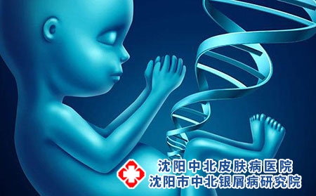 母亲有牛皮癣会遗传给孩子吗？