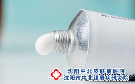 涂什么可以缓解牛皮癣？