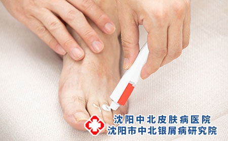 足部牛皮癣的日常护理