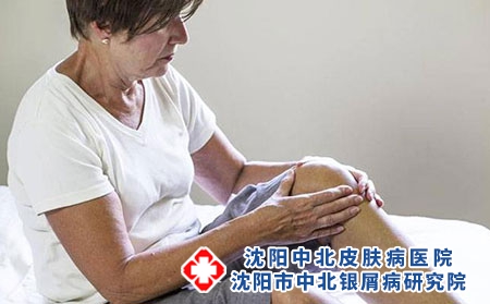 关节病型牛皮癣的常识有哪些呢