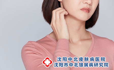 引起女性牛皮癣产生的因素?
