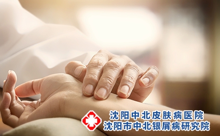 中医治疗牛皮癣的效果怎么样?