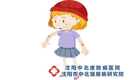 沈阳牛皮癣的病人怎么治疗好