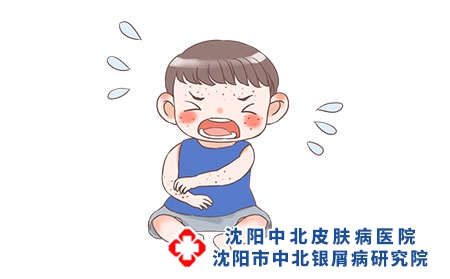 幼儿牛皮癣病因有哪些 什么因素让幼儿得牛皮癣